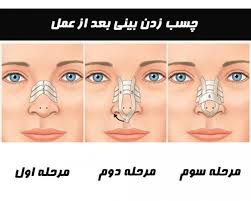 مراقبت بعد عمل جراحی زیبایی بینی